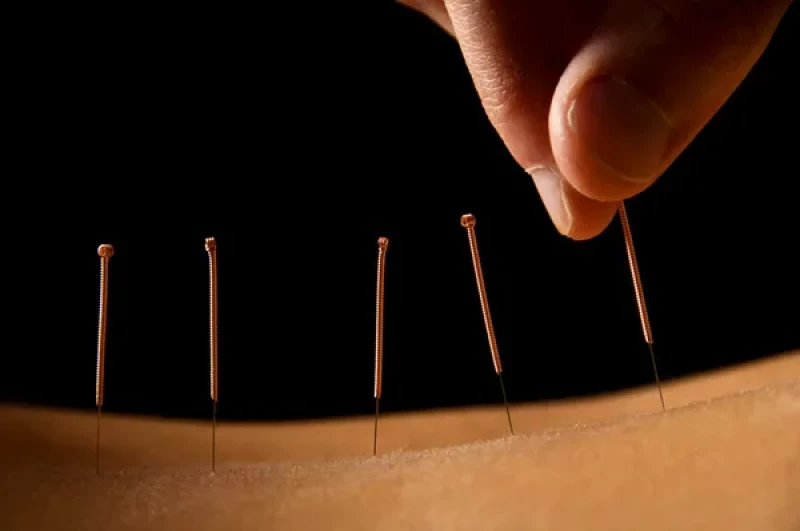 Acupuncture Treatment